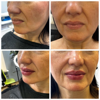 Корекція губ.Виправлення асиметрія і делікатне наповнення.