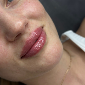 Збільшення губ