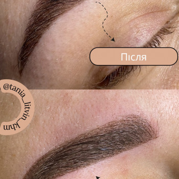 Вгорі загоєний перманент брів після першої процедури.
 