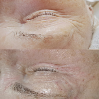 Бланшинг терапія