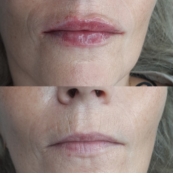 Збільшення губ Avalon ( корея)