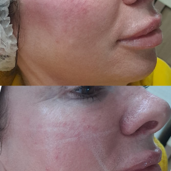 Контурна пластика скул 2мл