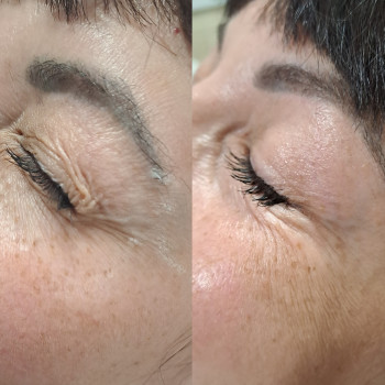 Результат до та після ботоксу , ефект 3-4міс