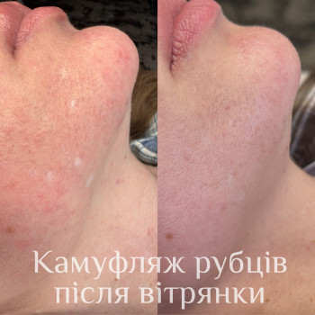 Камуфляж белых пятен витилиго или шрама
                    Салон красоты Mona Lisa Полтава