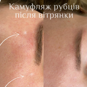 Камуфляж белых пятен витилиго или шрама
                    Салон красоты Mona Lisa Полтава