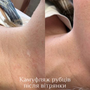 Камуфляж белых пятен витилиго или шрама
                    Салон красоты Mona Lisa Полтава