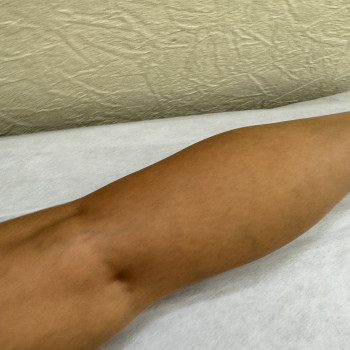 Працює на засмаглій шкірі