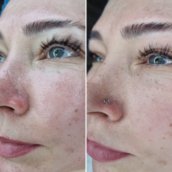 Чистка лица, Hydrofacial, ультразвуковая, механическая чистка
                    Косметолог-эстетист Влада Харьков