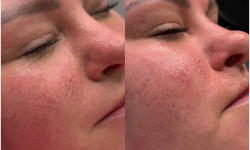 Микронидлинг Бровист Катерина Ровно