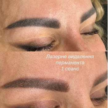 1 процедура