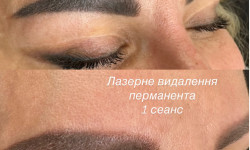 Лазерное удаление бровей Майстер перманентного макіяжу Ирина Полтава