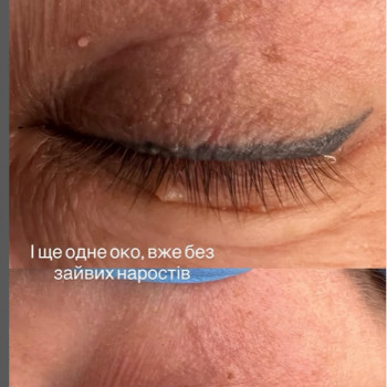 видалення бородавок