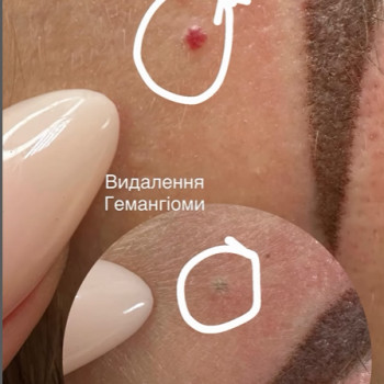 видалення гемангіом