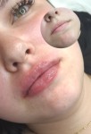 Збільшення губ 1ml Врач-косметолог Олеся Тернополь