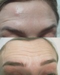 BOTOX  (три зони - знижка) Лікар-косметолог Олеся Тернопіль
