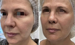 Полимолочная кислота лифтинг Лікар-косметолог Юлия Харків