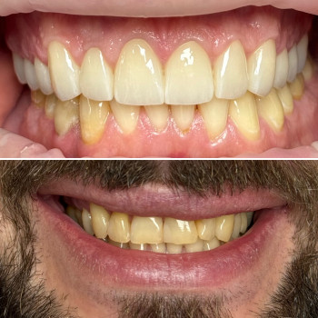 Відновлення посмішки цирконієвими коронками, фото - стоматолог Володимир Холод