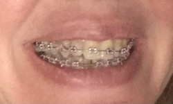 Установка брекетов Стоматолог Елена Одесса