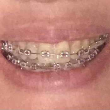 У процесі лікування