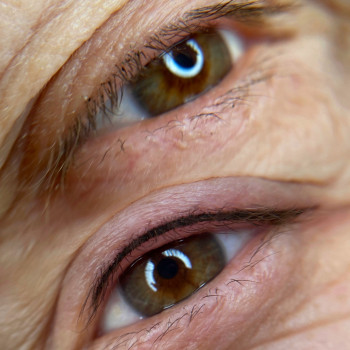 Міжвійковий прокрас на віковій шкірі