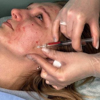 БІОРЕВІТАЛІЗАЦІЯ ОБЛИЧЧЯ
                    Косметолог Елена Винница