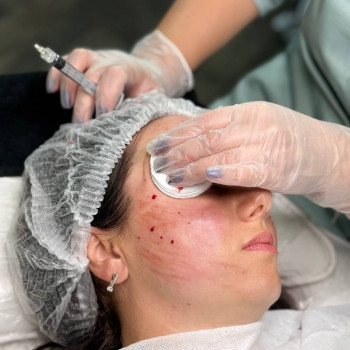 БІОРЕВІТАЛІЗАЦІЯ ОБЛИЧЧЯ
                    Косметолог Елена Винница