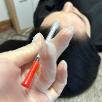 БОТУЛІНОТЕРАПІЯ
                    Косметолог Елена Винница