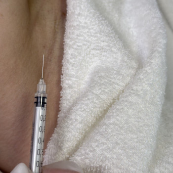 БОТУЛІНОТЕРАПІЯ
                    Косметолог Елена Винница