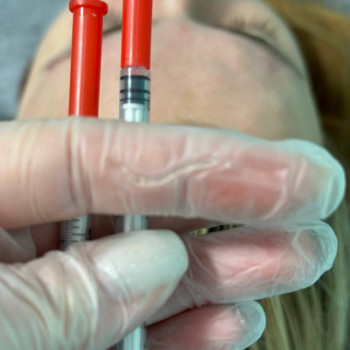 БОТУЛІНОТЕРАПІЯ
                    Косметолог Елена Винница