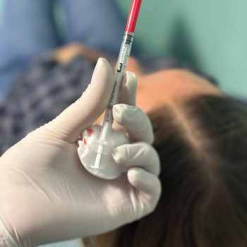 БОТУЛІНОТЕРАПІЯ
                    Косметолог Елена Винница