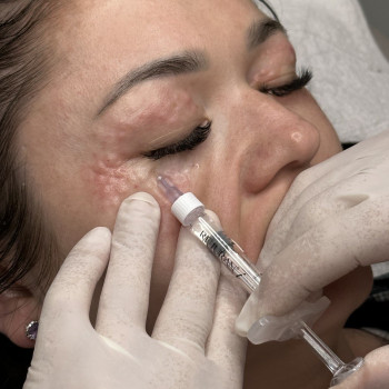 БІОРЕВІТАЛІЗАЦІЯ ЗОНИ НАВКОЛО ОЧЕЙ
                    Косметолог Елена Винница