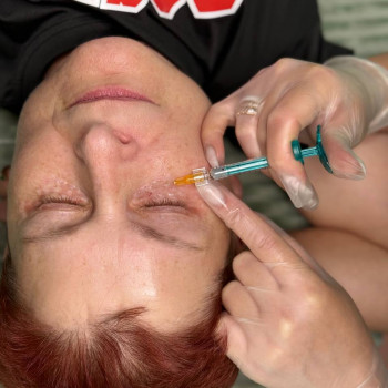 БІОРЕВІТАЛІЗАЦІЯ ЗОНИ НАВКОЛО ОЧЕЙ
                    Косметолог Елена Винница