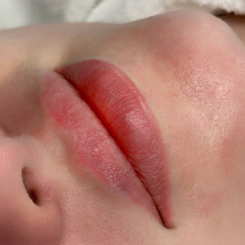 ЗБІЛЬШЕННЯ ГУБ
                    Косметолог Елена Винница