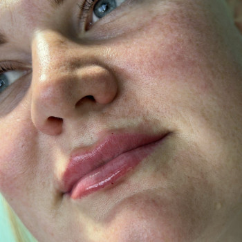 ЗБІЛЬШЕННЯ ГУБ
                    Косметолог Елена Винница