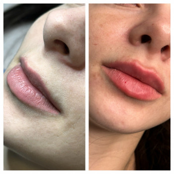 ЗБІЛЬШЕННЯ ГУБ
                    Косметолог Елена Винница