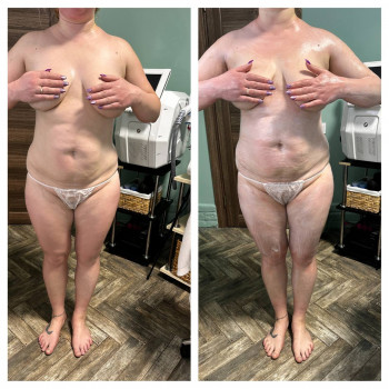 ОБГОРТАННЯ ТІЛА
                    Косметолог Елена Винница