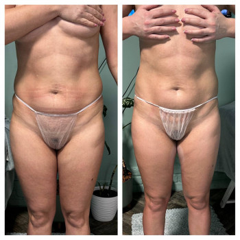 ОБГОРТАННЯ ТІЛА
                    Косметолог Елена Винница