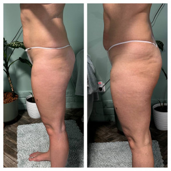 ОБГОРТАННЯ ТІЛА
                    Косметолог Елена Винница