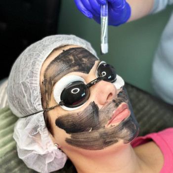 КАРБОНОВИЙ ПІЛІНГ
                    Косметолог Елена Винница