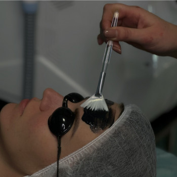 КАРБОНОВИЙ ПІЛІНГ
                    Косметолог Елена Винница