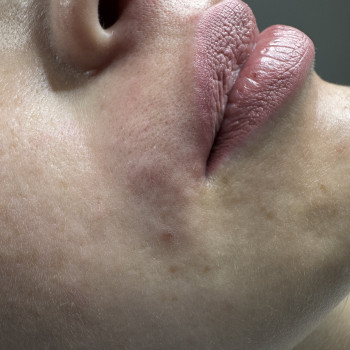 ЕЛЕКТРОЕПІЛЯЦІЯ зони обличчя