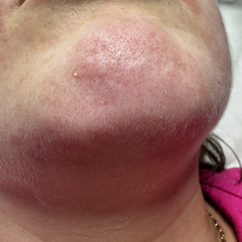 Видалення світлого волосся за допомогою ЕЛЕКТРОЕПІЛЯЦІЇ