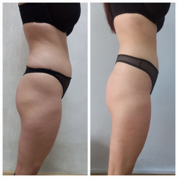 20 сеансів: Л/ліполіз,RF-ліфтинг, вакуумний, Л/д, обгортання
 
  
 