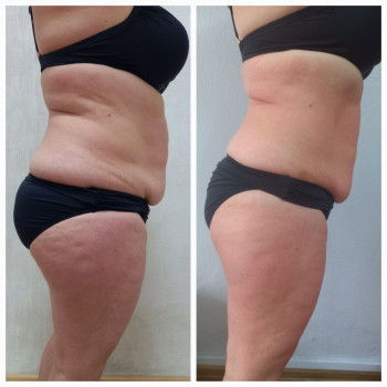 20 сеансів: кавітація,RF-ліфтинг, вакуумний, Л/д, обгортання
 
  
 