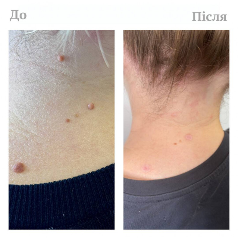 Радіохвильове видалення родимок, фото - Косметологический центр Dr.  Abraamyan Clinic