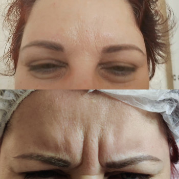 ботулинотерапия, ботокс