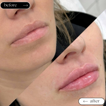  

 

 

 

 ’єкціїКраси

 

 