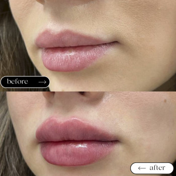  

 

 

 

 ’єкціїКраси

 

 