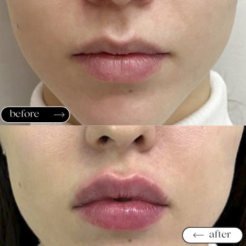  

 

 

 

 ’єкціїКраси

 

 