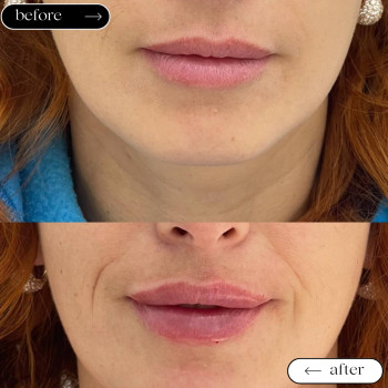  

 

 

 

 ’єкціїКраси

 

 